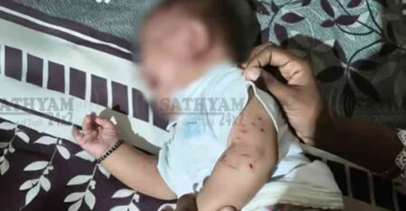 കോട്ടക്കലിൽ ഉറങ്ങിക്കിടന്ന അഞ്ചുമാസം പ്രായമുള്ള കുഞ്ഞിനെ തെരുവുനായ ആക്രമിച്ചു ഗുരുതര പരിക്ക്